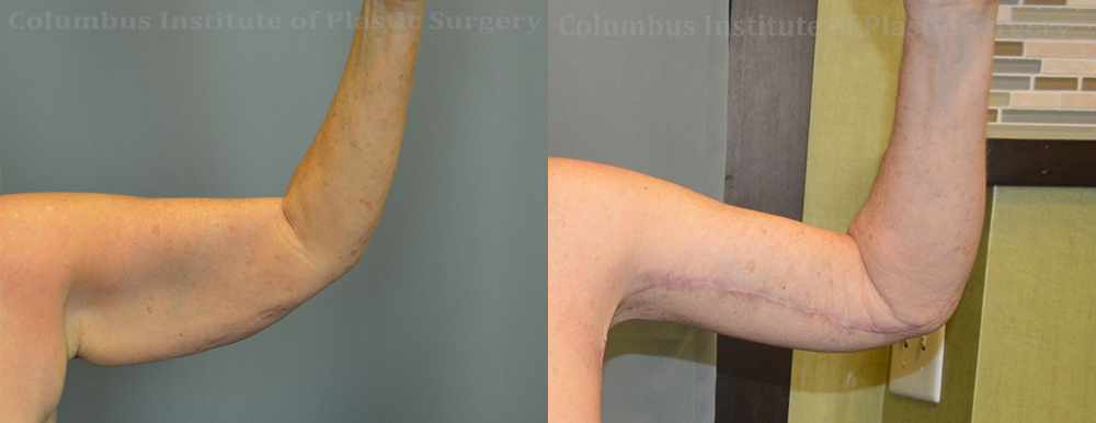 Brachioplasty (Arm Lift) before and after photo by Columbus Institute of Plastic Surgery in Columbus, OH