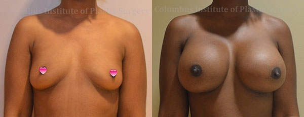Breast Augmentation with Gummy Bear (Form Stable) Implants before and after photo by Columbus Institute of Plastic Surgery