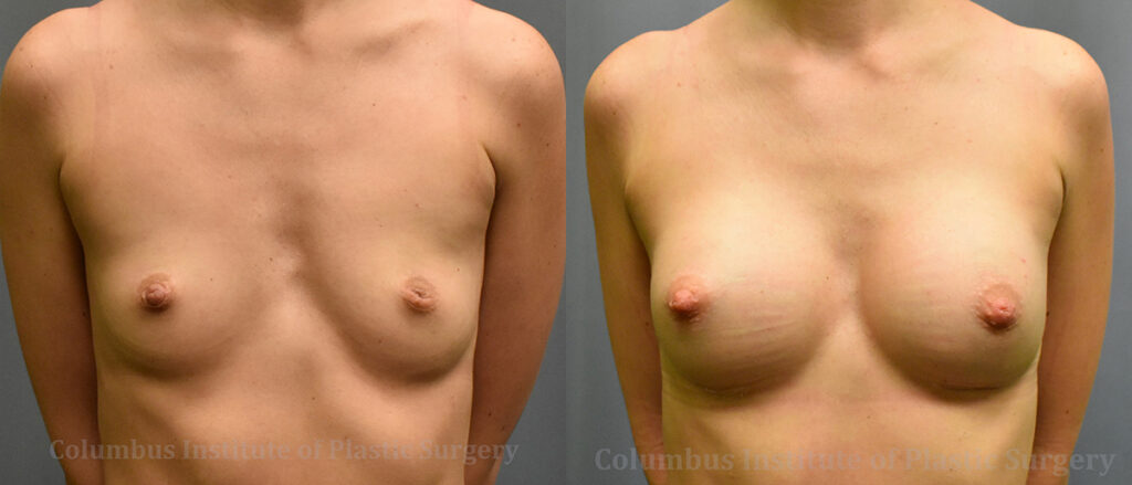 Breast Augmentation – 200cc-300cc before and after photo by Columbus Institute of Plastic Surgery in Columbus, OH