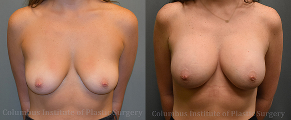 Breast Augmentation – 300cc-400cc before and after photo by Columbus Institute of Plastic Surgery in Columbus, OH