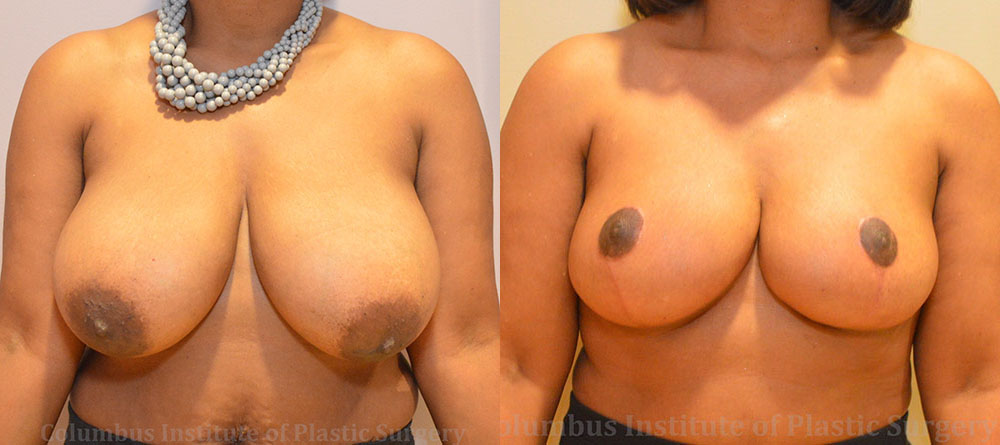 Breast Reduction before and after photo by Columbus Institute of Plastic Surgery in Columbus, OH