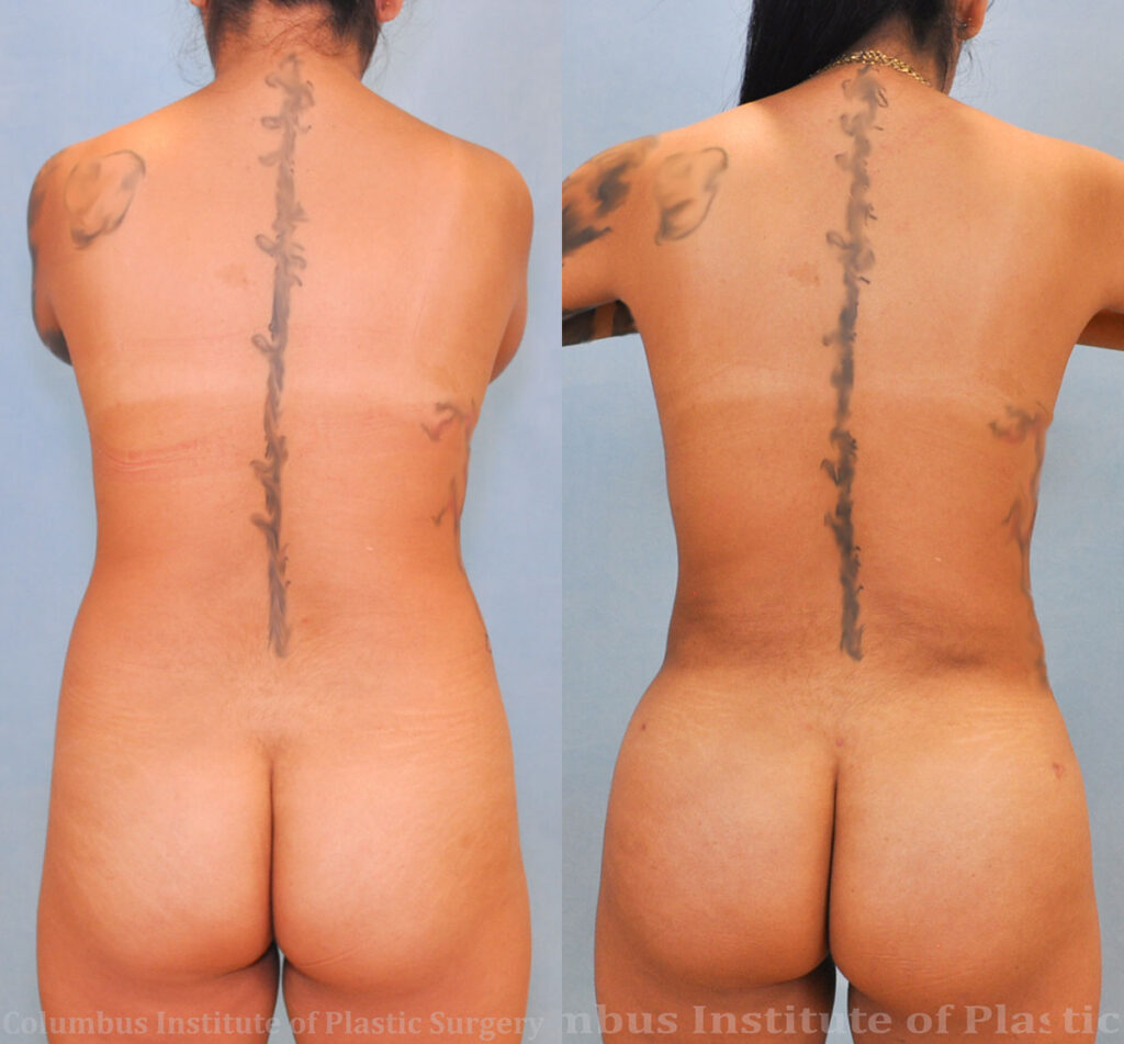 Liposuction before and after photo by Columbus Institute of Plastic Surgery in Columbus, OH