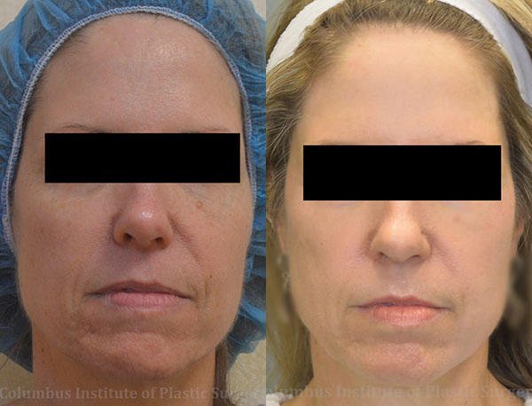 TCA Chemical Peel before and after photo by Columbus Institute of Plastic Surgery in Columbus, OH