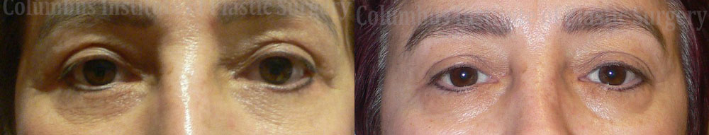 Blepharoplasty before and after photo by Columbus Institute of Plastic Surgery in Columbus, OH