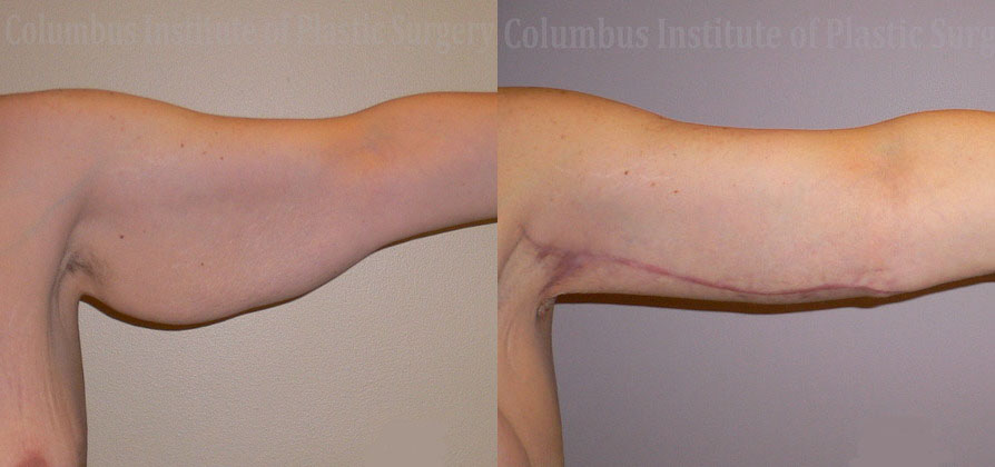 Brachioplasty (Arm Lift) before and after photo by Columbus Institute of Plastic Surgery in Columbus, OH