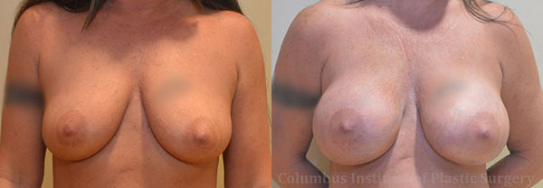 Breast Augmentation – 400cc-500cc before and after photo by Columbus Institute of Plastic Surgery in Columbus, OH