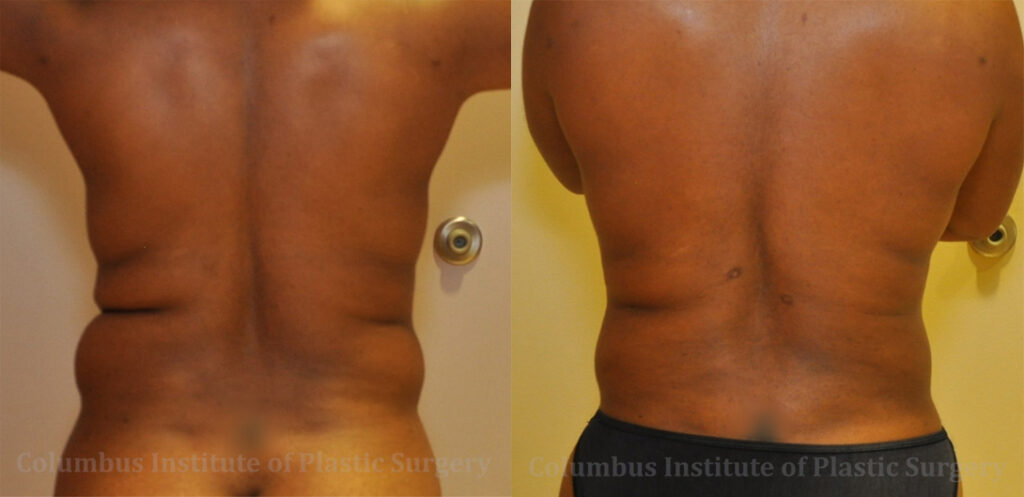 Liposuction before and after photo by Columbus Institute of Plastic Surgery in Columbus, OH