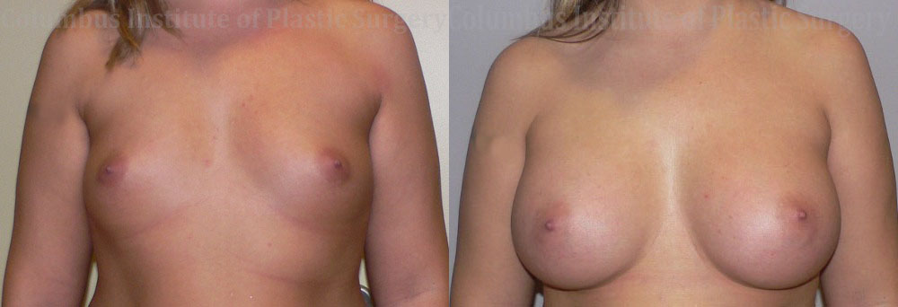 Breast Augmentation before and after photo by Columbus Institute of Plastic Surgery in Columbus, OH