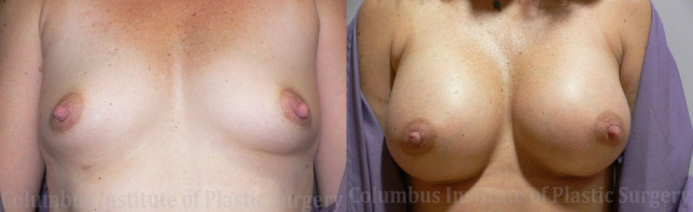 Breast Augmentation before and after photo by Columbus Institute of Plastic Surgery in Columbus, OH