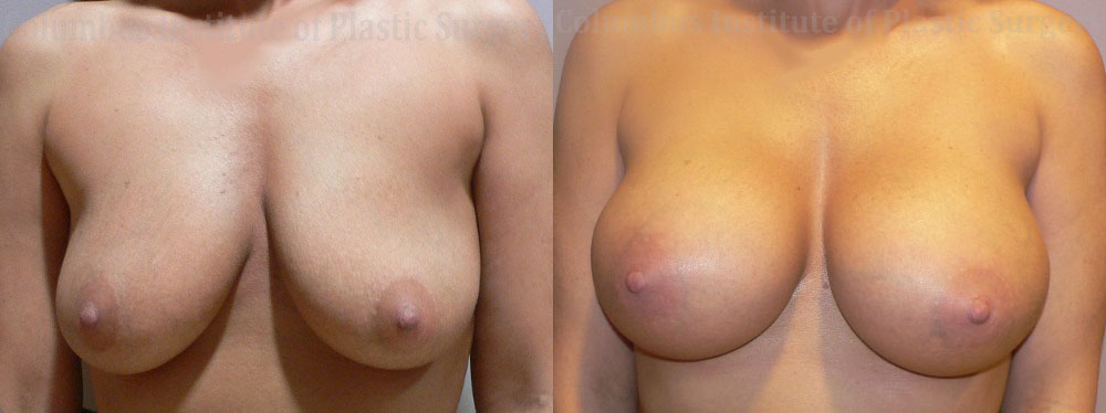 Breast Augmentation before and after photo by Columbus Institute of Plastic Surgery in Columbus, OH