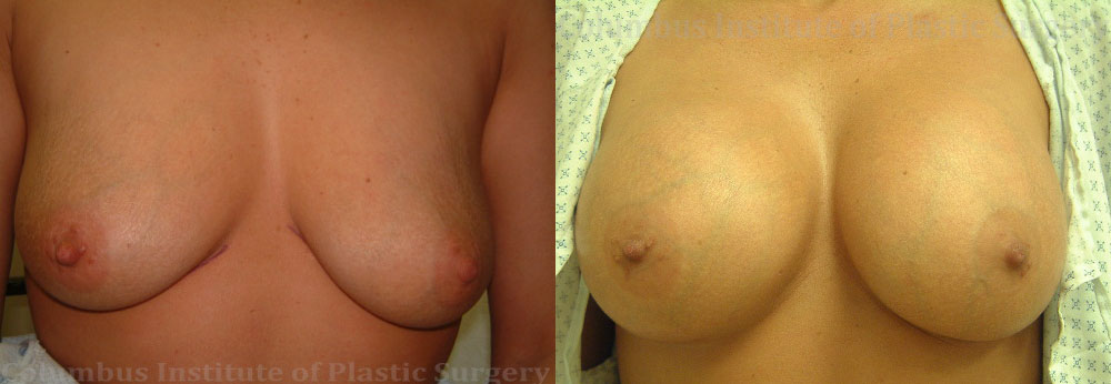 Breast Augmentation before and after photo by Columbus Institute of Plastic Surgery in Columbus, OH