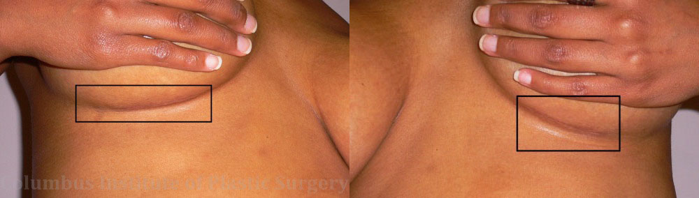 Breast Augmentation before and after photo by Columbus Institute of Plastic Surgery in Columbus, OH