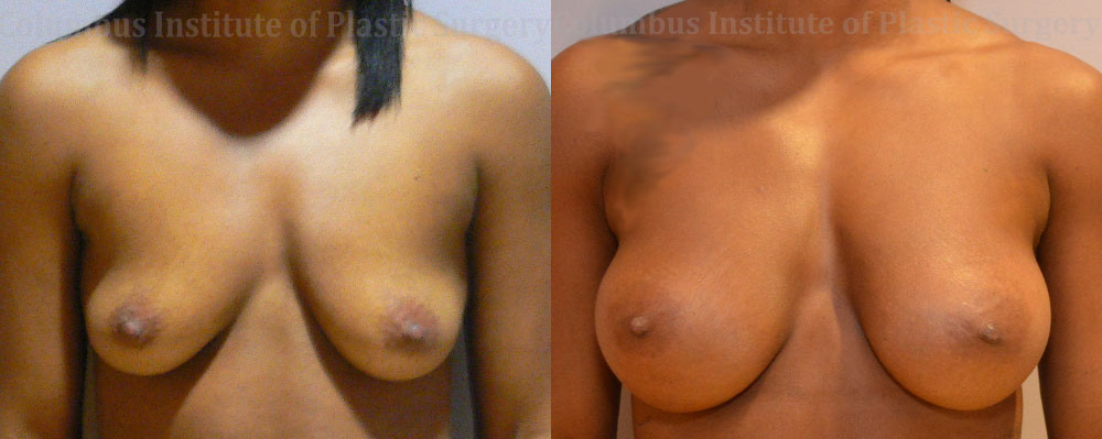 Breast Augmentation before and after photo by Columbus Institute of Plastic Surgery in Columbus, OH