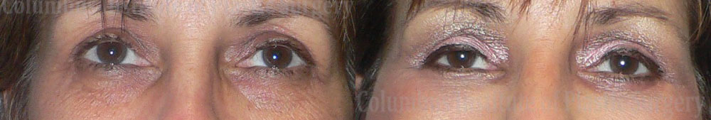 Blepharoplasty before and after photo by Columbus Institute of Plastic Surgery in Columbus, OH