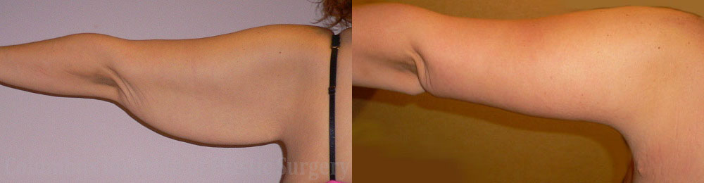 Brachioplasty (Arm Lift) before and after photo by Columbus Institute of Plastic Surgery in Columbus, OH