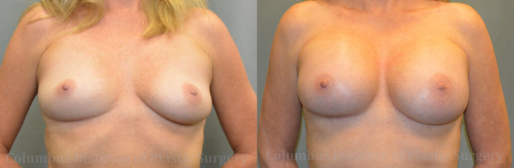 Breast Augmentation – 500cc-600cc before and after photo by Columbus Institute of Plastic Surgery in Columbus, OH