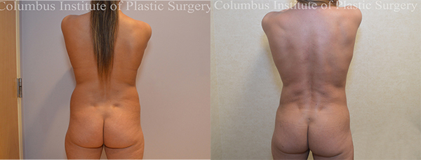 Liposuction before and after photo by Columbus Institute of Plastic Surgery in Columbus, OH