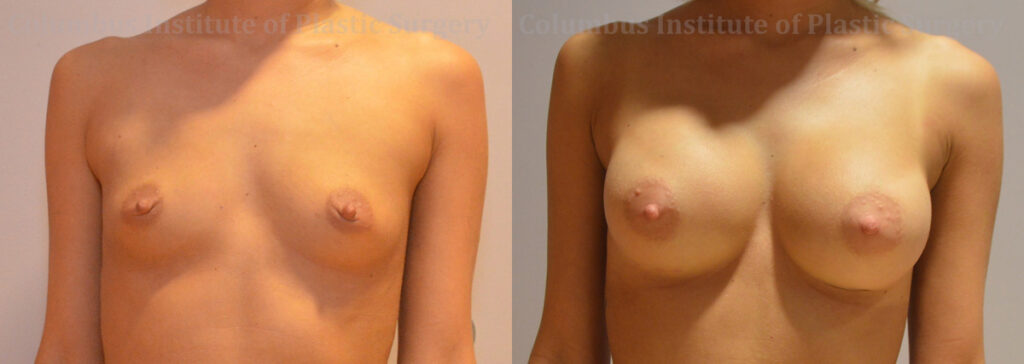 Breast Augmentation before and after photo by Columbus Institute of Plastic Surgery in Columbus, OH