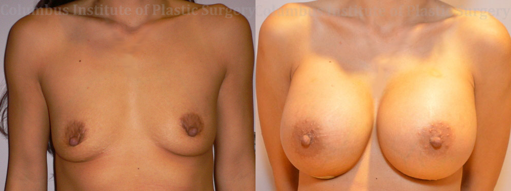 Breast Augmentation before and after photo by Columbus Institute of Plastic Surgery in Columbus, OH