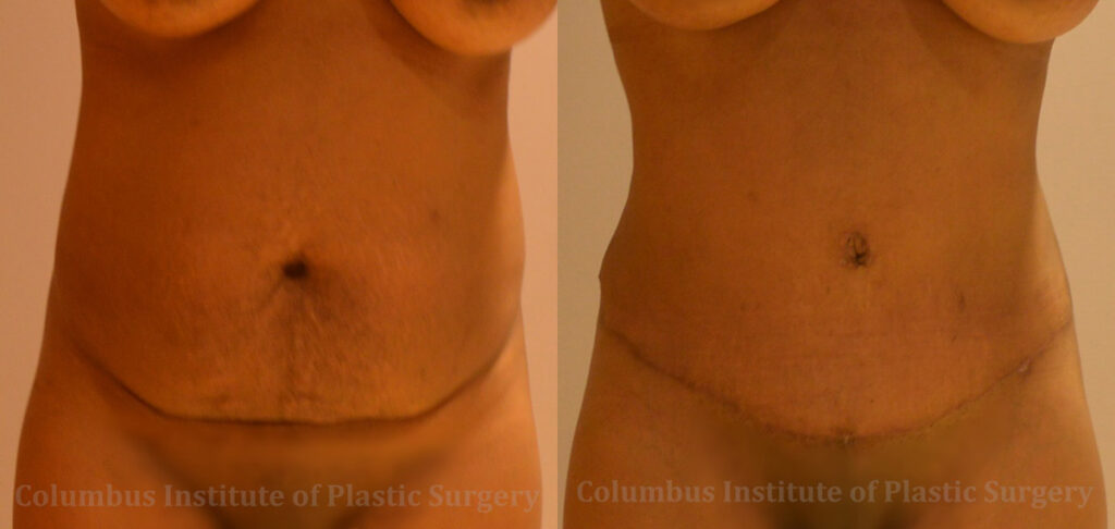 Abdominoplasty (Tummy Tuck) before and after photo by Columbus Institute of Plastic Surgery in Columbus, OH