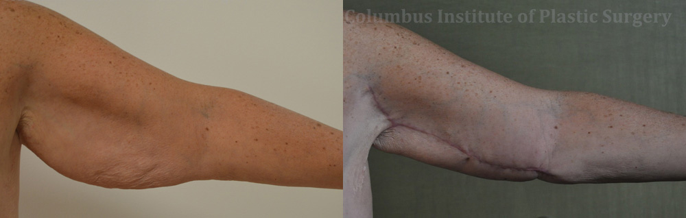 Brachioplasty (Arm Lift) before and after photo by Columbus Institute of Plastic Surgery in Columbus, OH