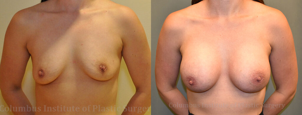 Breast Augmentation before and after photo by Columbus Institute of Plastic Surgery in Columbus, OH