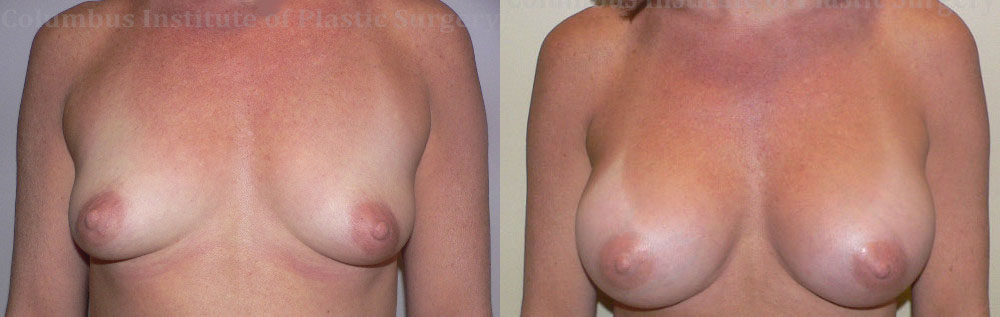 Breast Augmentation – 300cc-400cc before and after photo by Columbus Institute of Plastic Surgery in Columbus, OH