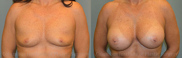 Breast Augmentation – 500cc-600cc before and after photo by Columbus Institute of Plastic Surgery in Columbus, OH