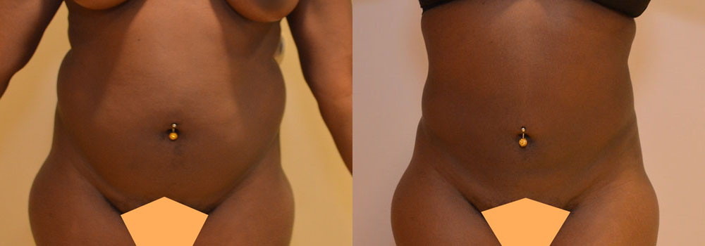 Liposuction before and after photo by Columbus Institute of Plastic Surgery in Columbus, OH