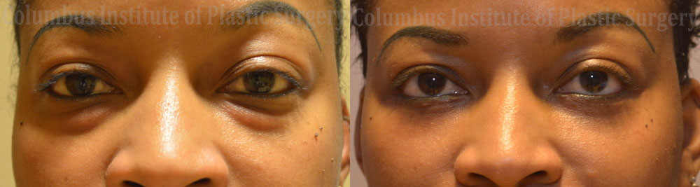 Blepharoplasty before and after photo by Columbus Institute of Plastic Surgery in Columbus, OH