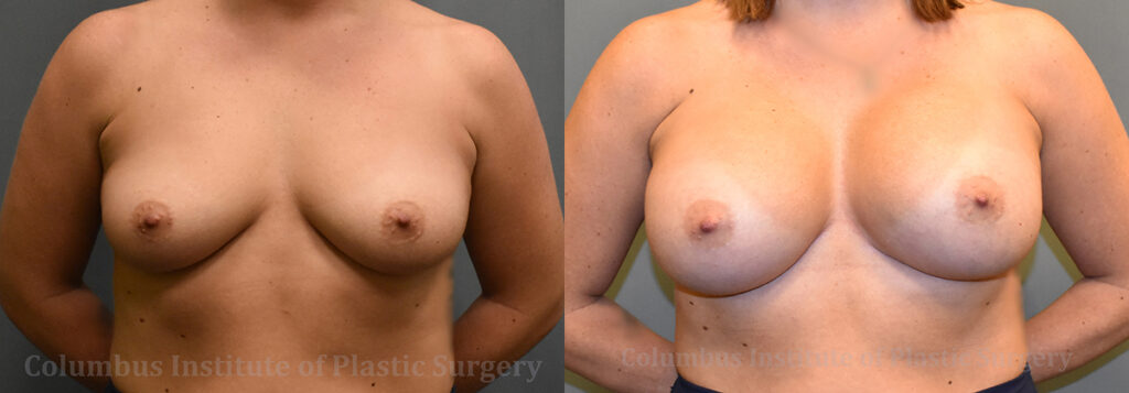 Breast Augmentation before and after photo by Columbus Institute of Plastic Surgery in Columbus, OH