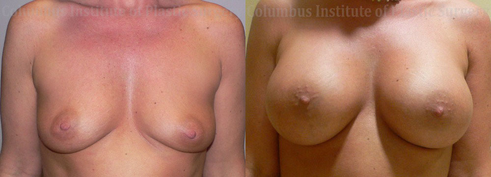 Breast Augmentation – 400cc-500cc before and after photo by Columbus Institute of Plastic Surgery in Columbus, OH
