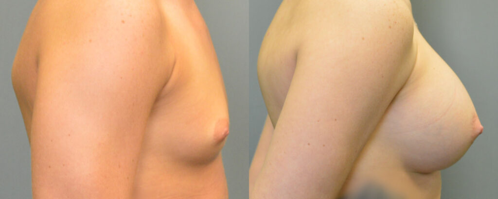 Breast Augmentation – 500cc-600cc before and after photo by Columbus Institute of Plastic Surgery in Columbus, OH