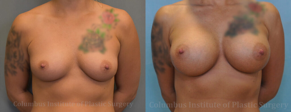 Breast Augmentation before and after photo by Columbus Institute of Plastic Surgery in Columbus, OH