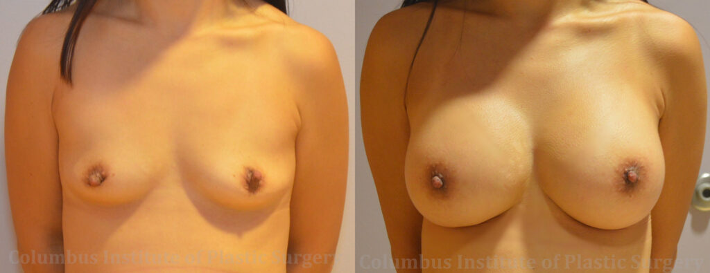 Breast Augmentation – 300cc-400cc before and after photo by Columbus Institute of Plastic Surgery in Columbus, OH