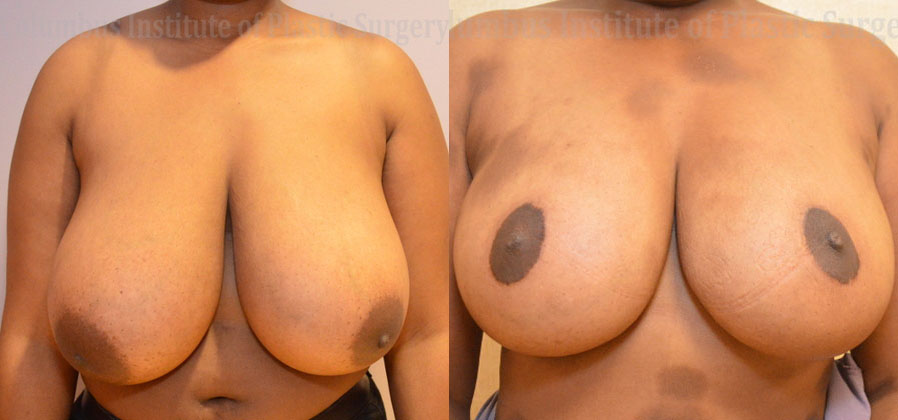 Breast Reduction before and after photo by Columbus Institute of Plastic Surgery in Columbus, OH