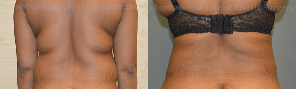 Liposuction before and after photo by Columbus Institute of Plastic Surgery in Columbus, OH