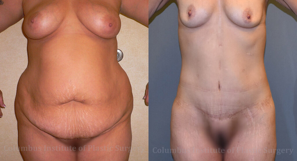Abdominoplasty (Tummy Tuck) before and after photo by Columbus Institute of Plastic Surgery in Columbus, OH