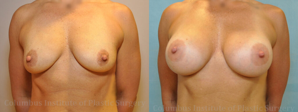Breast Augmentation before and after photo by Columbus Institute of Plastic Surgery in Columbus, OH