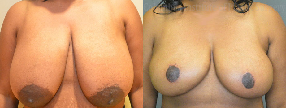 Breast Reduction before and after photo by Columbus Institute of Plastic Surgery in Columbus, OH
