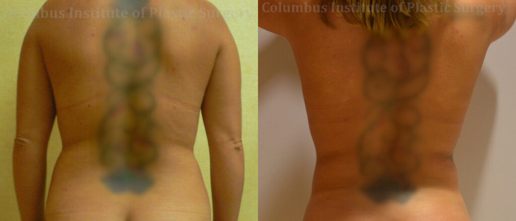 Liposuction before and after photo by Columbus Institute of Plastic Surgery in Columbus, OH