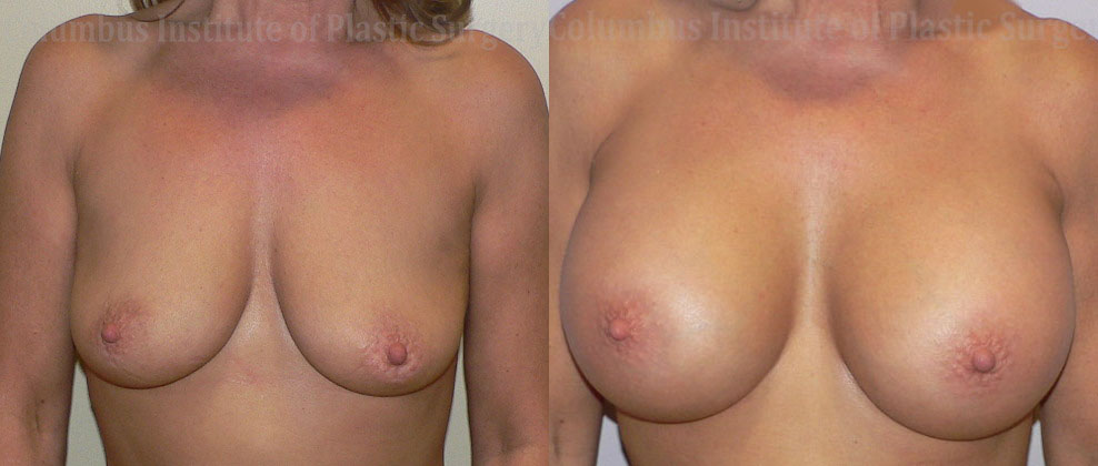 Breast Augmentation – 500cc-600cc before and after photo by Columbus Institute of Plastic Surgery in Columbus, OH