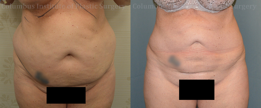 Liposuction before and after photo by Columbus Institute of Plastic Surgery in Columbus, OH
