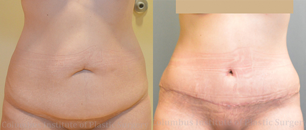 Abdominoplasty (Tummy Tuck) before and after photo by Columbus Institute of Plastic Surgery in Columbus, OH
