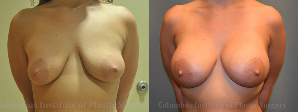 Breast Augmentation before and after photo by Columbus Institute of Plastic Surgery in Columbus, OH
