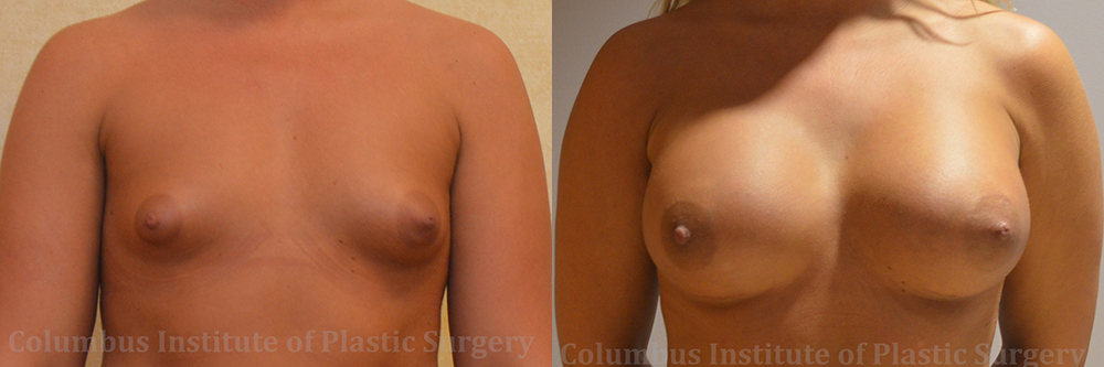 Breast Augmentation – 500cc-600cc before and after photo by Columbus Institute of Plastic Surgery in Columbus, OH