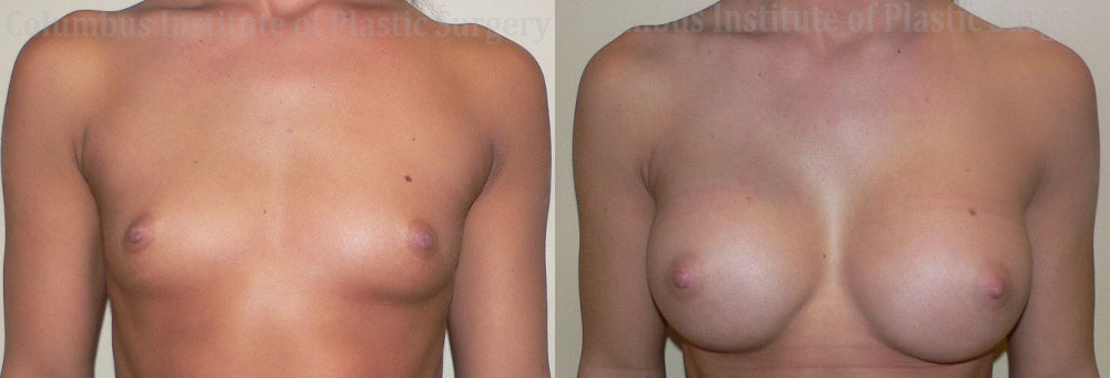 Breast Augmentation – 400cc-500cc before and after photo by Columbus Institute of Plastic Surgery in Columbus, OH