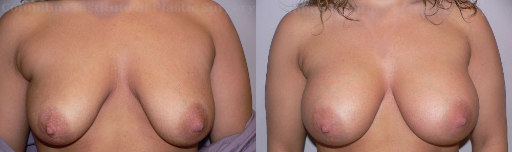 Breast Augmentation – 300cc-400cc before and after photo by Columbus Institute of Plastic Surgery in Columbus, OH