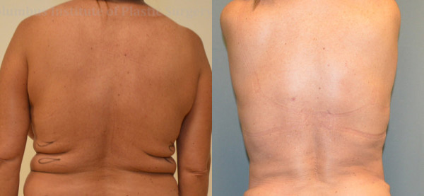 Liposuction before and after photo by Columbus Institute of Plastic Surgery in Columbus, OH