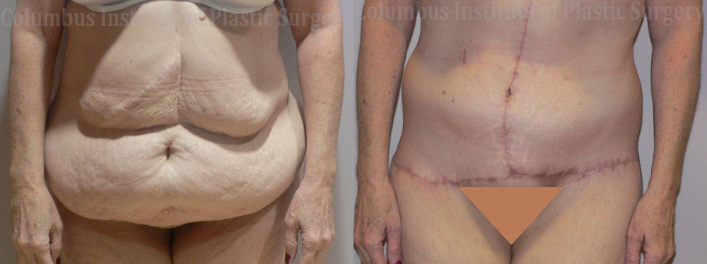 Belt Lipectomy before and after photo by Columbus Institute of Plastic Surgery in Columbus, OH